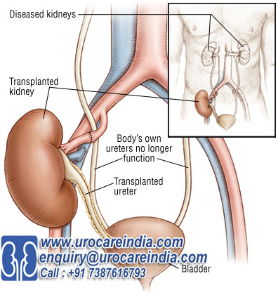 Kidney Transplant Surgery India At Low Cost – Kidney Transplant Cost1